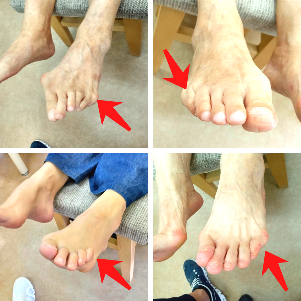 内反小趾 小ゆびの痛み の解決方法 外反母趾 足の痛み専門 整足院武蔵小杉店