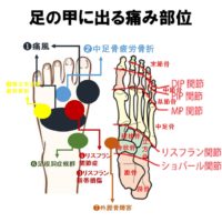 リスフラン関節症の対処方法 外反母趾 足の痛み専門 整足院武蔵小杉店