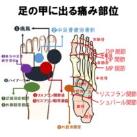 痛風の痛みについて 外反母趾 足の痛み専門 整足院武蔵小杉店